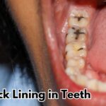 Black Lining in Teeth