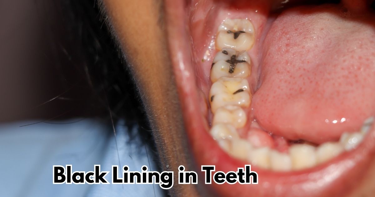 Black Lining in Teeth