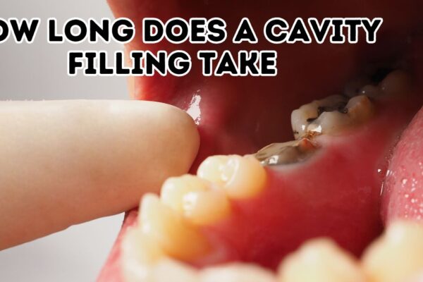 How Long Does a Cavity Filling Take