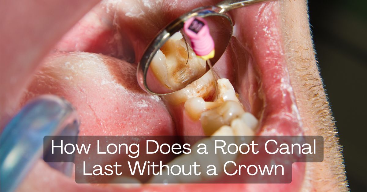 How Long Does a Root Canal Last Without a Crown